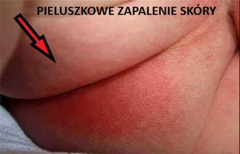 Pieluszkowe zapalenie skóry 