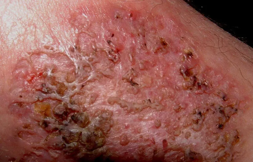 Piodermia zgorzelinowa