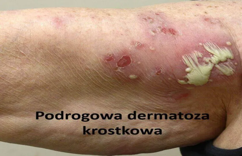 Podrogowa dermatoza krostkowa 