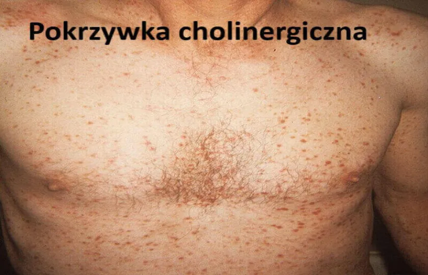 Pokrzywka cholinergiczna 