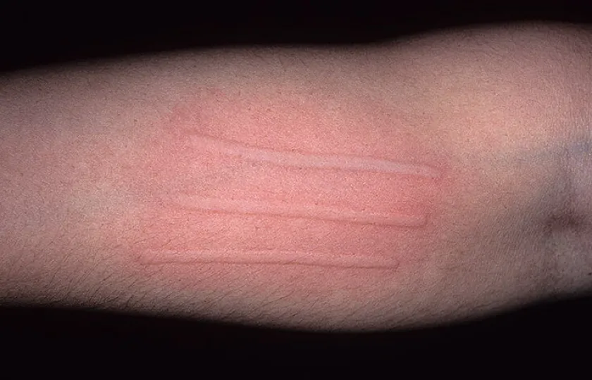 Pokrzywka dermograficzna
