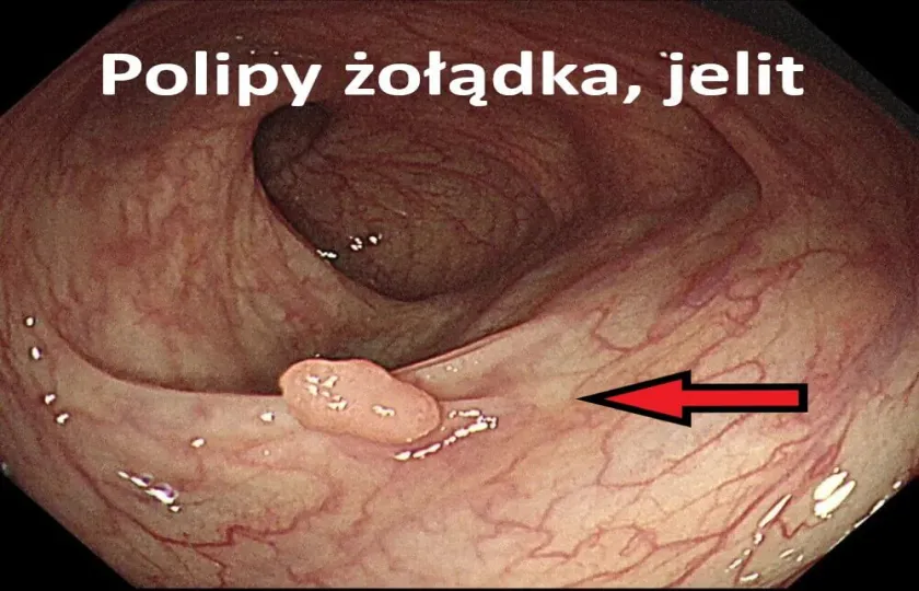 Polipy żołądka, jelit  