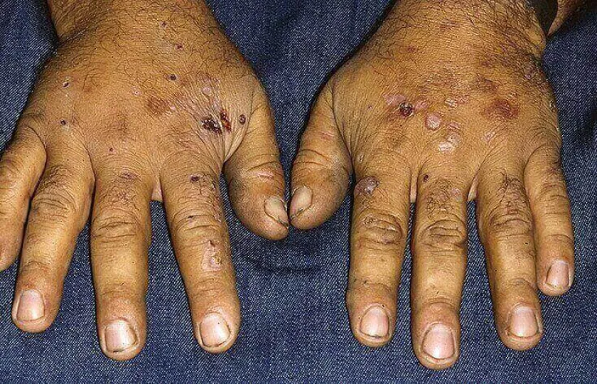 Porfiria skórna późna 