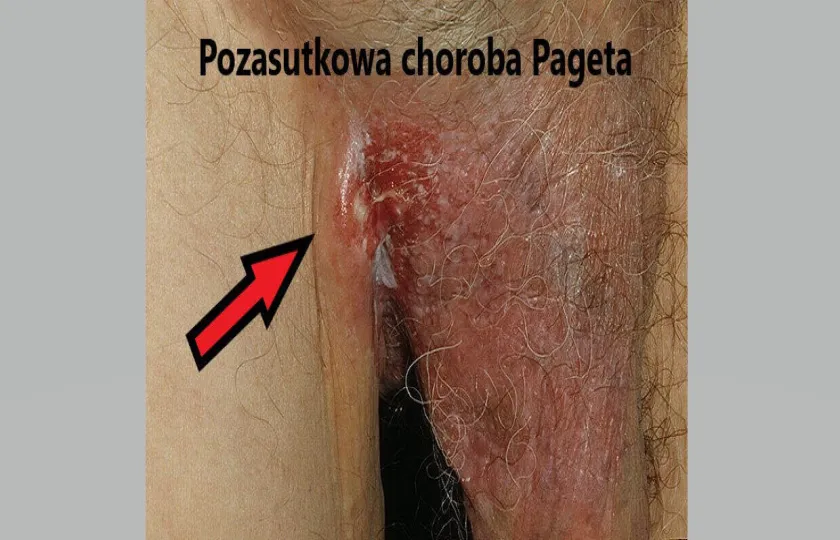 Pozasutkowa choroba Pageta