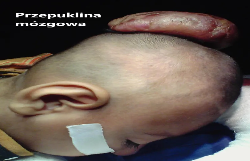 PRZEPUKLINA MÓZGOWA 