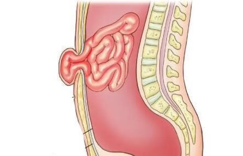 Przepuklina pępkowa