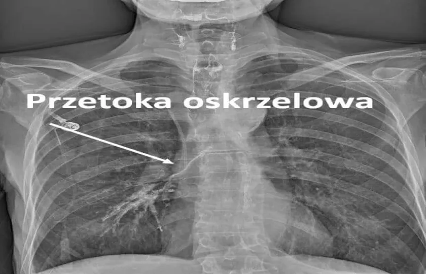 Przetoka oskrzelowa