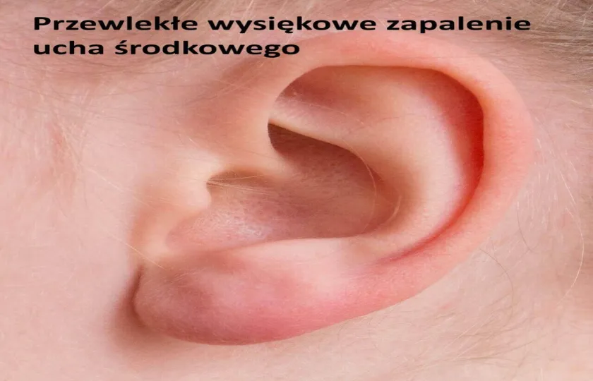 Przewlekłe wysiękowe zapalenie ucha środkowego 