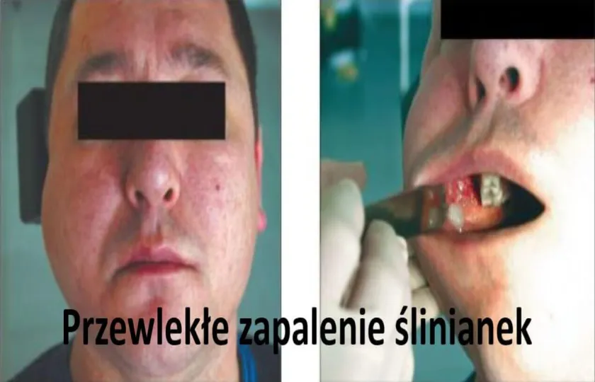 Przewlekłe zapalenie ślinianek