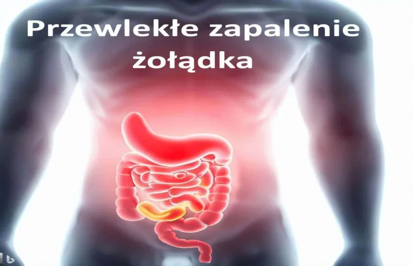 Przewlekłe zapalenie żołądka