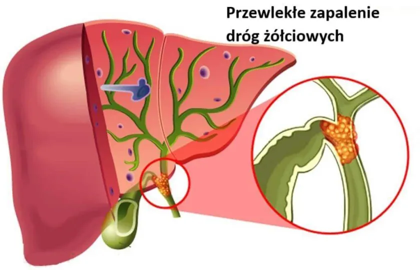 Przewlekłe zapalenie dróg żółciowych