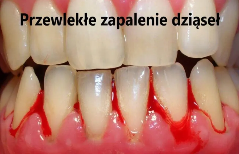 Przewlekłe zapalenie dziąseł
