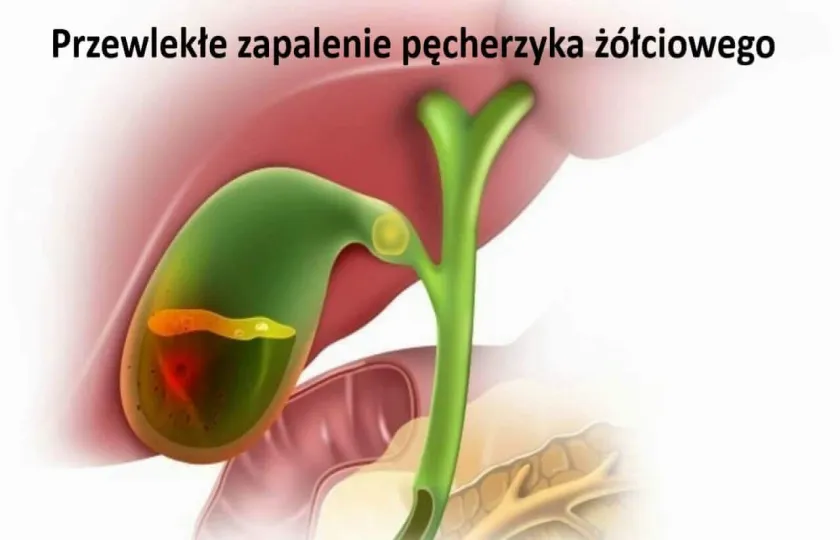 Przewlekłe zapalenie pęcherzyka żółciowego 