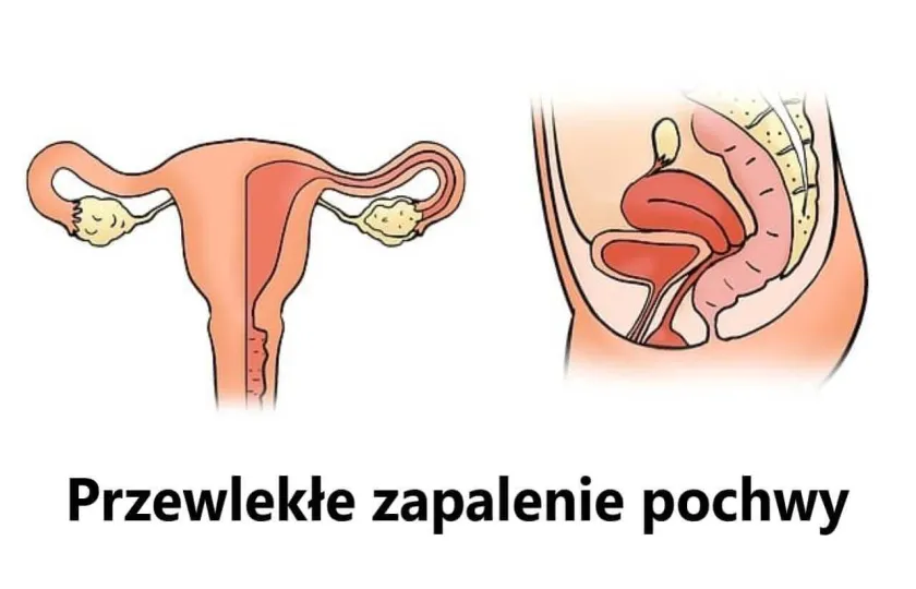 Przewlekłe zapalenie pochwy