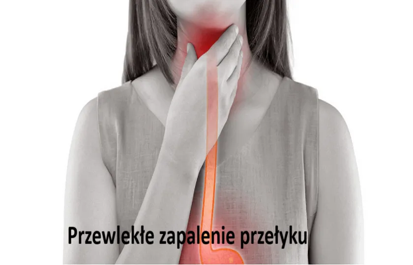 Przewlekłe zapalenie przełyku