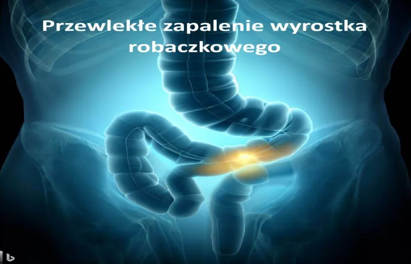 Przewlekłe zapalenie wyrostka robaczkowego