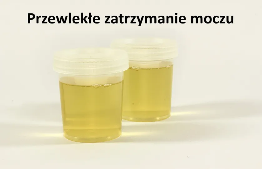 Przewlekłe zatrzymanie moczu