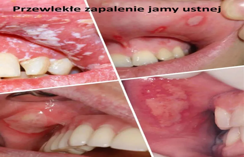 Przewlekłe zapalenie jamy ustnej