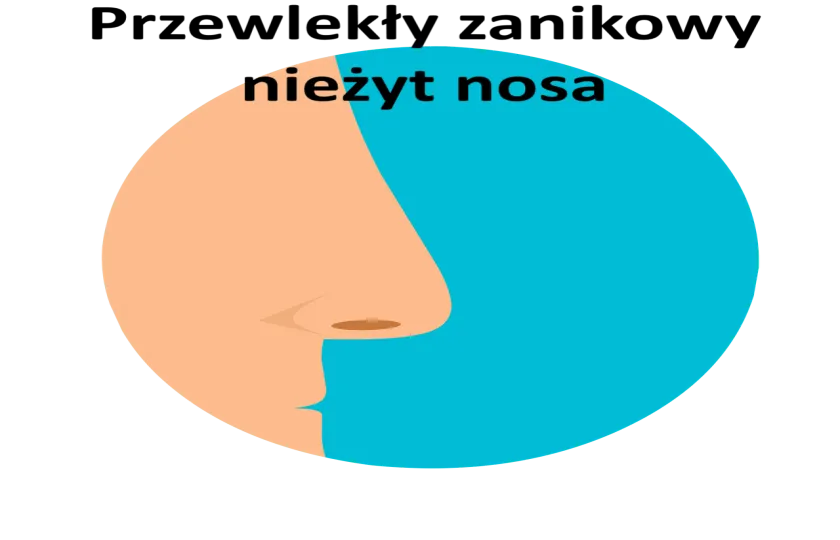 Przewlekły zanikowy nieżyt nosa, Zanikowy nieżyt nosa 