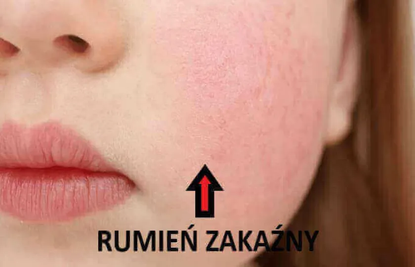 RUMIEŃ ZAKAŹNY