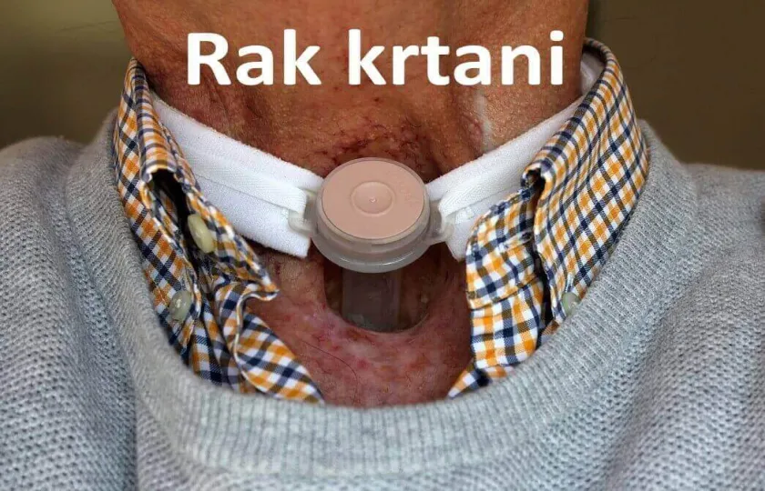 Rak krtani