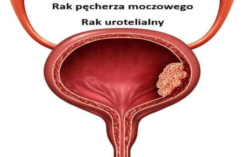 rak pęcherza moczowego