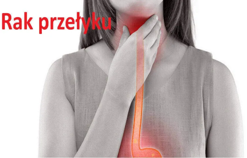 Rak przełyku 