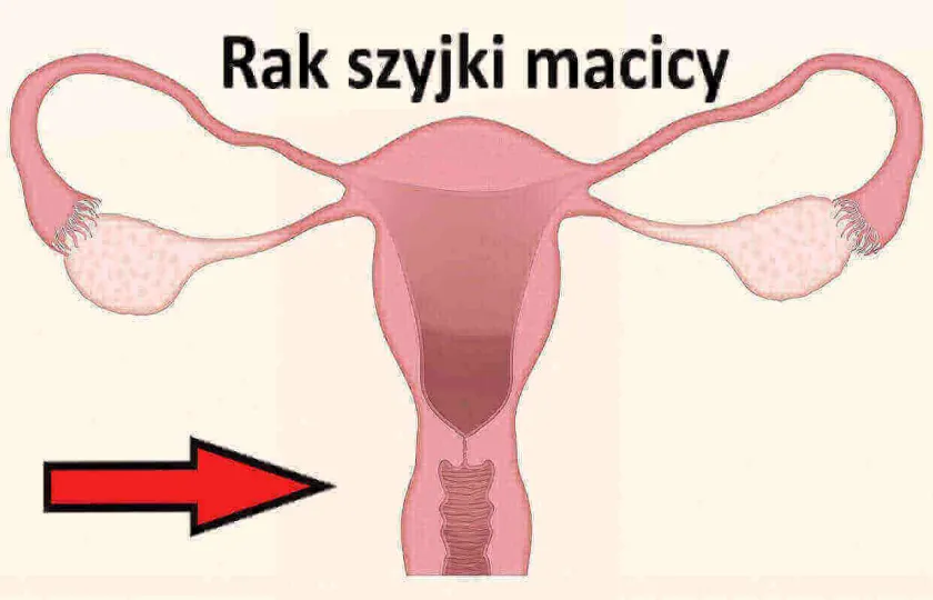 Rak szyjki macicy