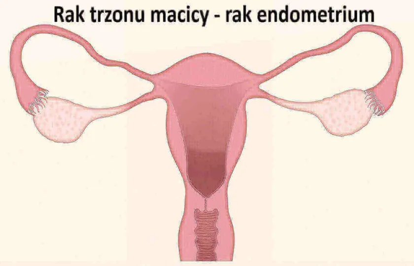 Rak trzonu macicy