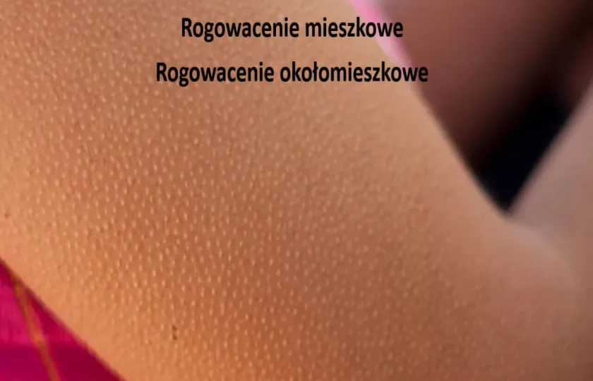 Rogowacenie mieszkowe, rogowacenie okołomieszkowe, gęsia skórka