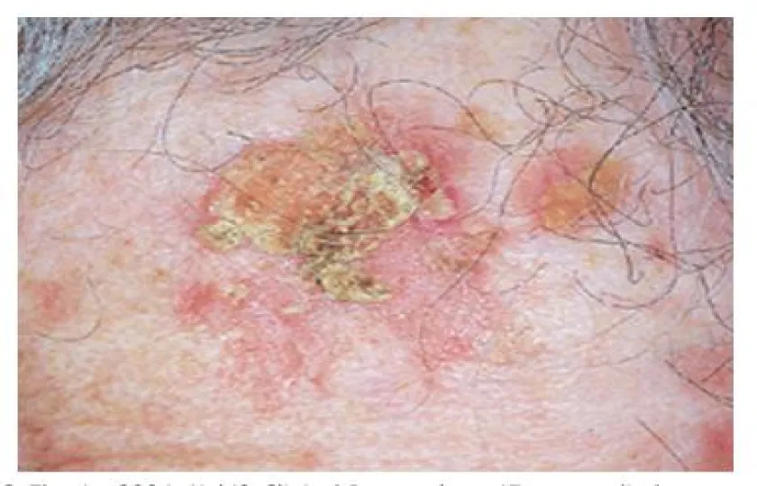 Rogowacenie słoneczne skóry 