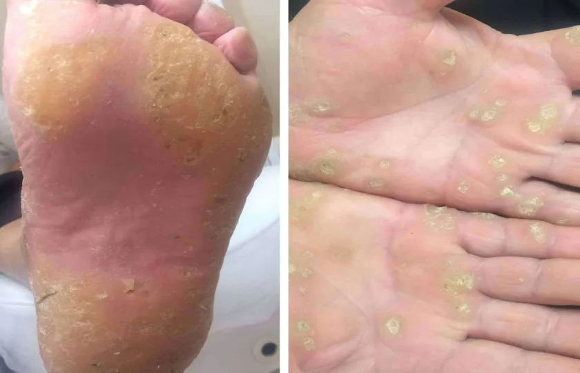 Rogowacenie skóry keratoderma