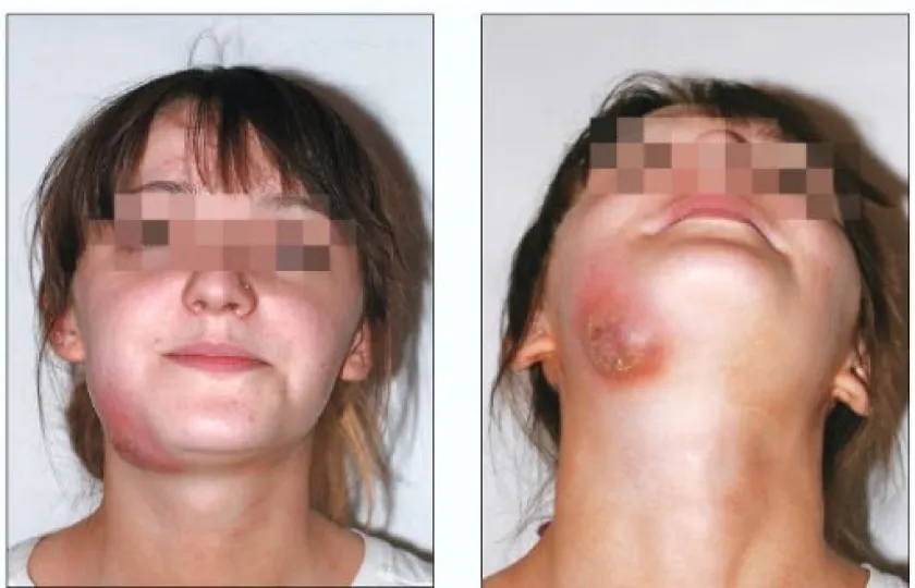 Ropień podżuchwowy