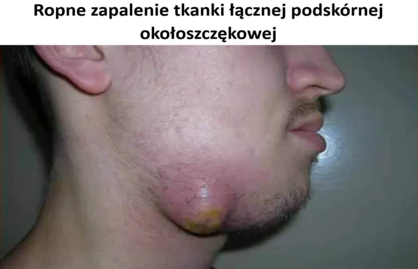 ropowica okołoszczękowa, Ropne zapalenie tkanki łącznej podskórnej okołoszczękowej 