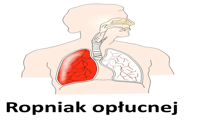 Ropniak opłucnej 