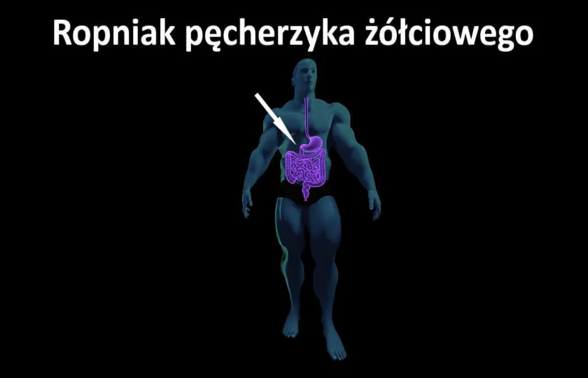 Ropniak pęcherzyka żółciowego 