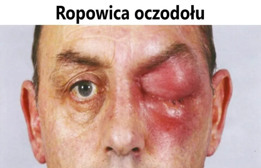 Ropowica oczodołu