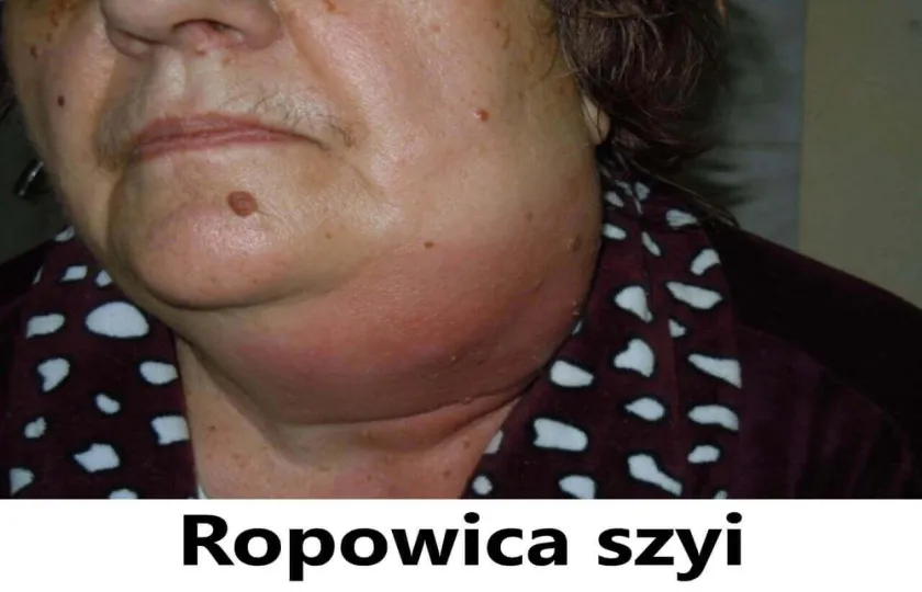 Ropowica szyi