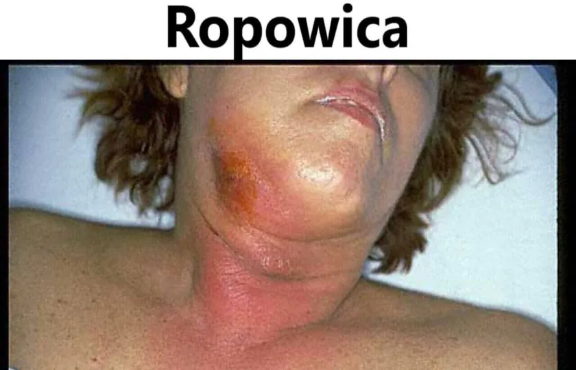 Ropowica, flegmona 