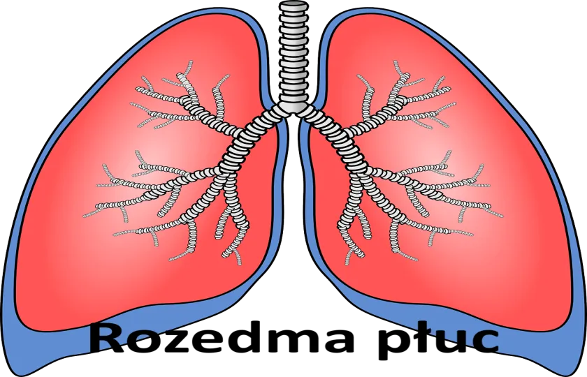 Rozedma płuc 