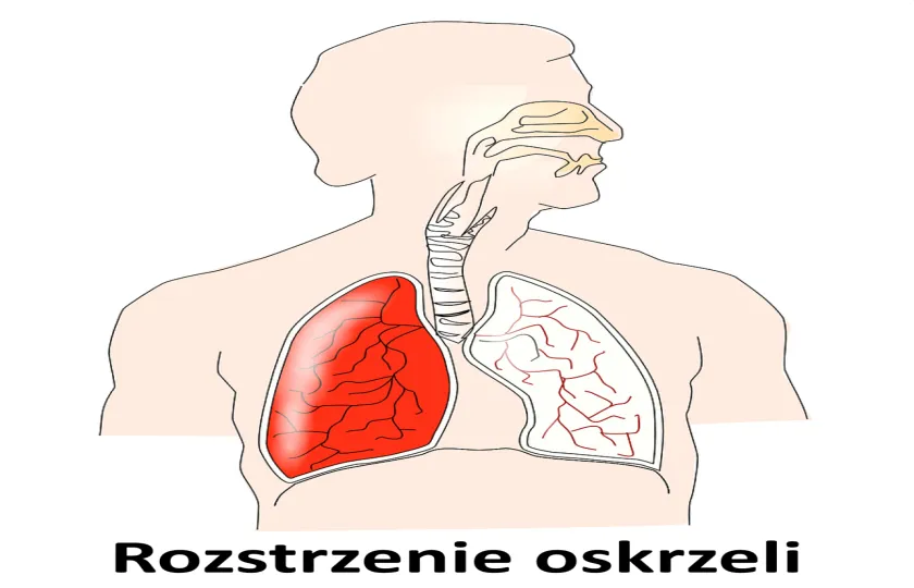 Rozstrzenie oskrzeli