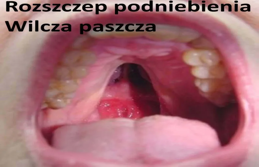 Rozszczep podniebienia, wilcza paszcza 