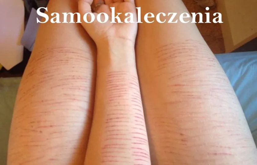 SAMOOKALECZENIE, samookaleczenie, okaleczanie siebie, ranienie samego siebie, uszkodzenie ciała