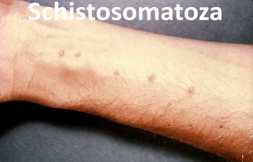 Schistosomatoza 