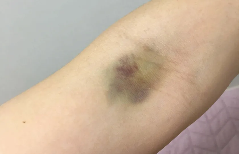 Siniak po pobraniu krwi