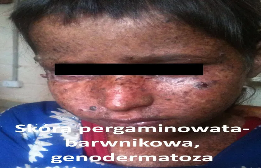 Skóra pergaminowata-barwnikowa, genodermatoza 