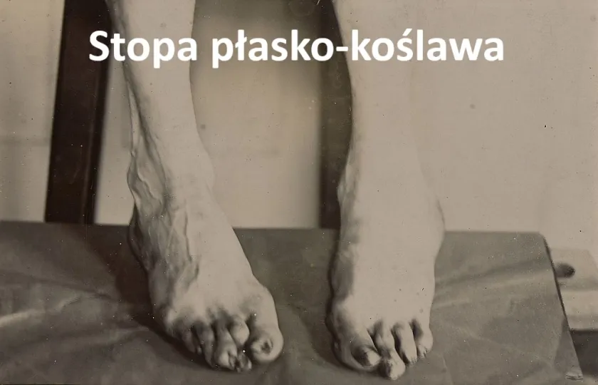 Stopa płasko-koślawa