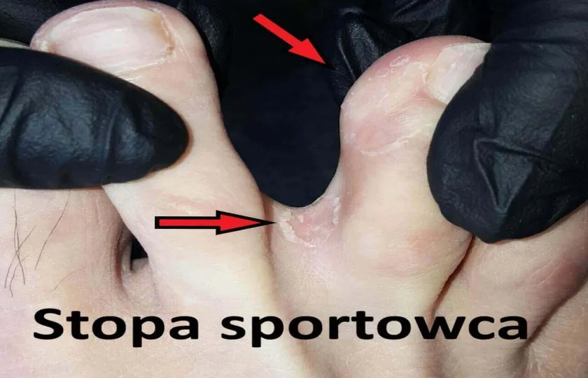 Stopa sportowca 