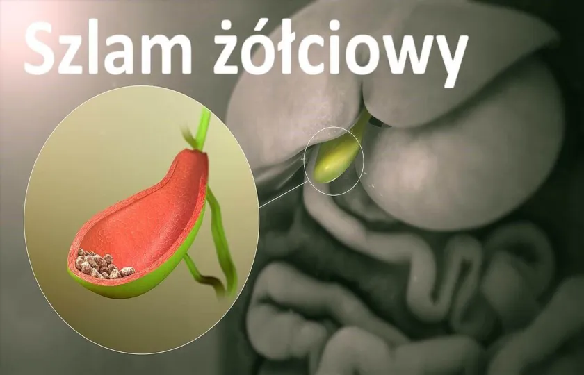 Szlam żółciowy
