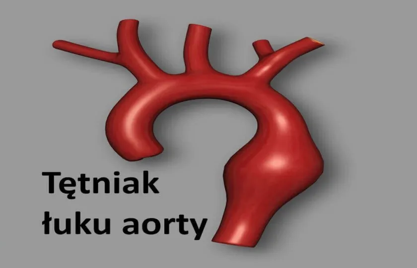Tętniak łuku aorty 